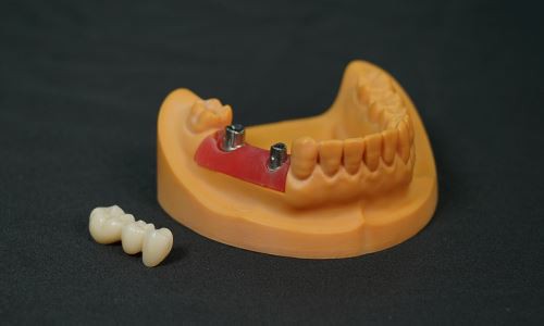 zirconia-bridge-Implant